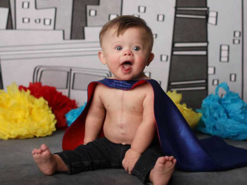 baby with down syndrome wearing superhero cape