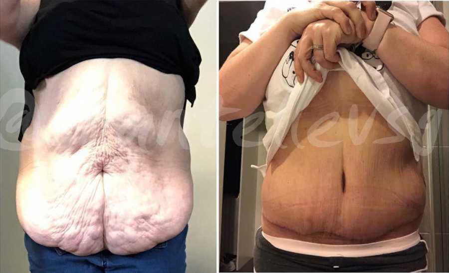 loose skin after weight loss surgery