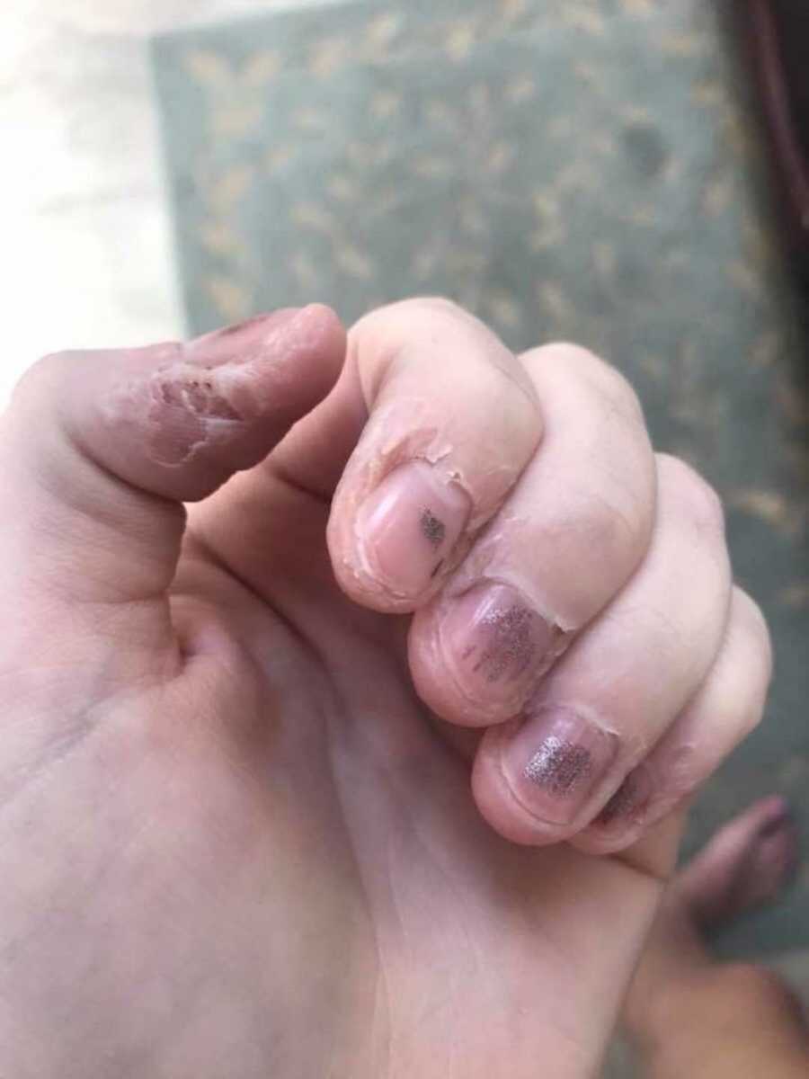 hand of person with anxiety who bites their nails and cuticles