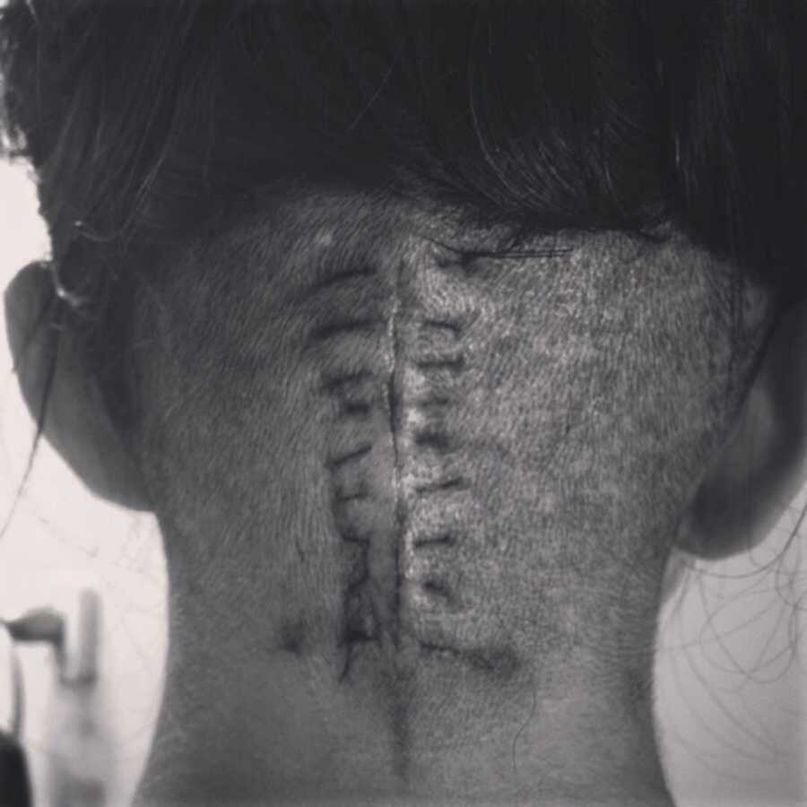 Girl with stitches in back of head with shaved hair