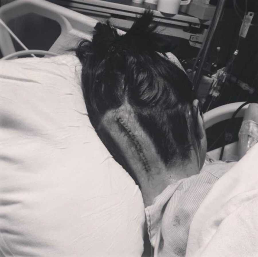 Med student lying in bed with stitches in back of head
