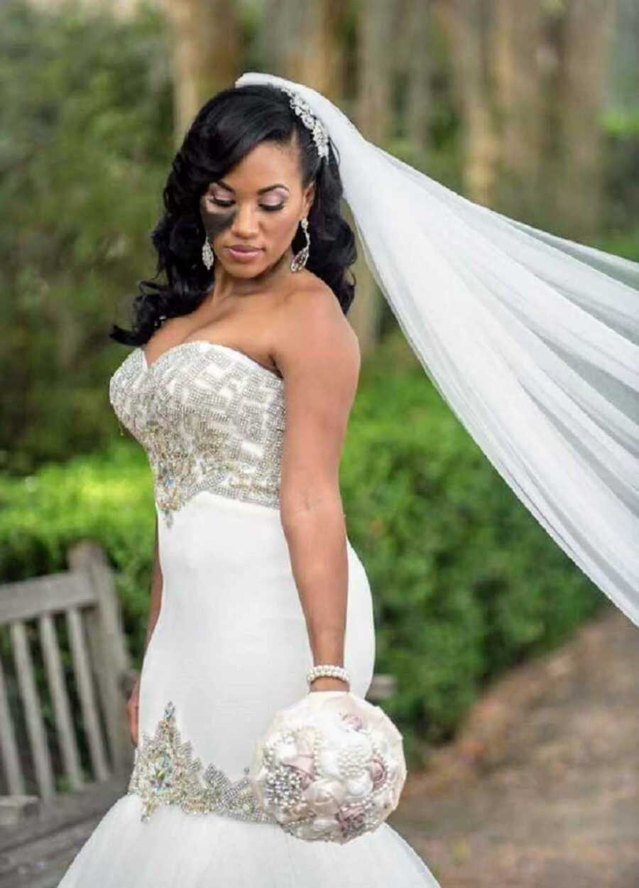 Bride with nevus birthmark posing in wedding dress