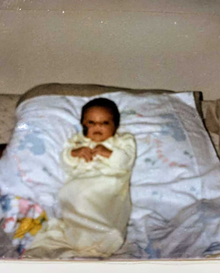 Infant with nevus birthmark lying on blanket