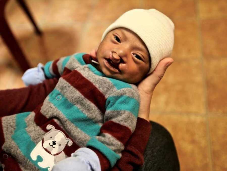 Guatemalan newborn with cleft lip and palate wearing striped pajamas