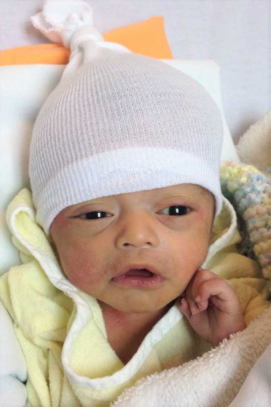 Newborn with Hydranencephaly lying in yellow onesie