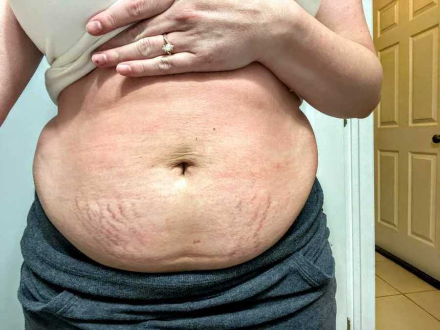 mom shows stretch marks to share body positivity