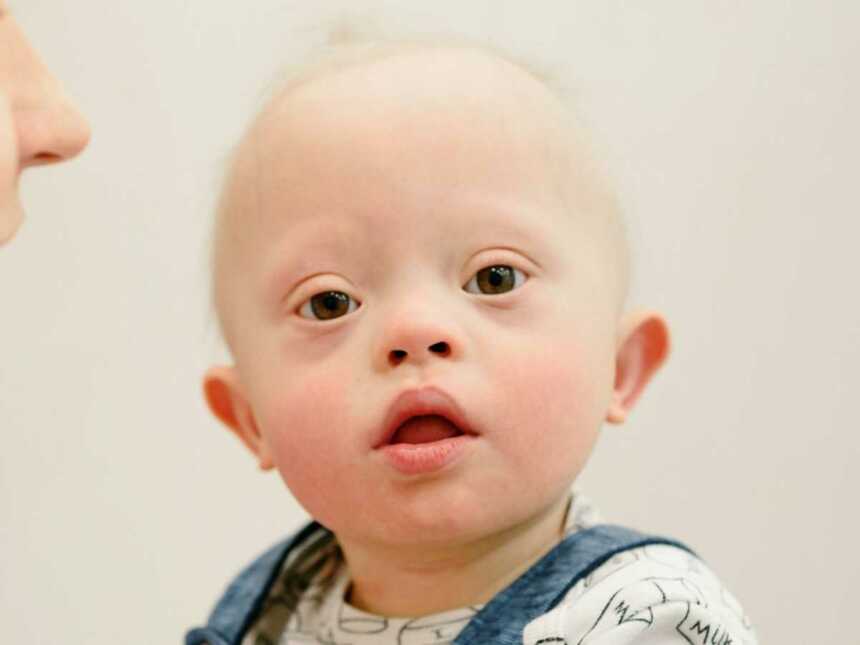 baby with down syndrome looks into camera