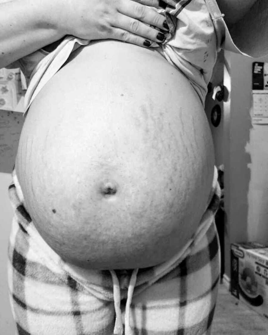 pregnant woman shows stretch marks