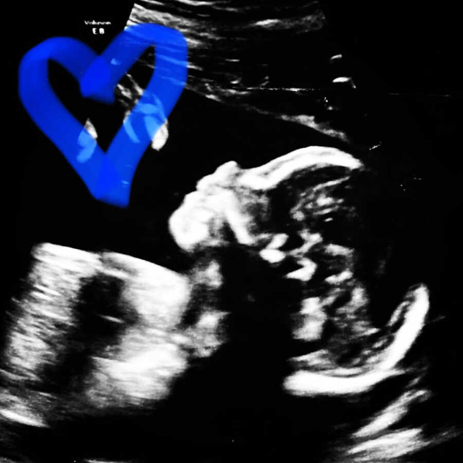 ultrasound of baby boy before he is born