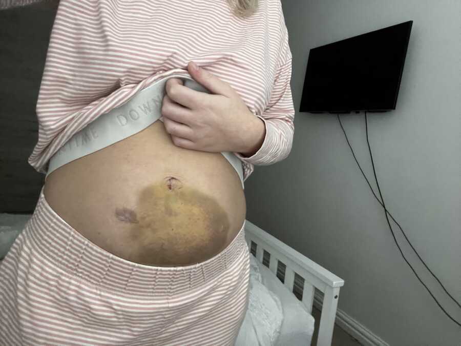 woman with endometriosis holds up shirt revealing bruised stomach