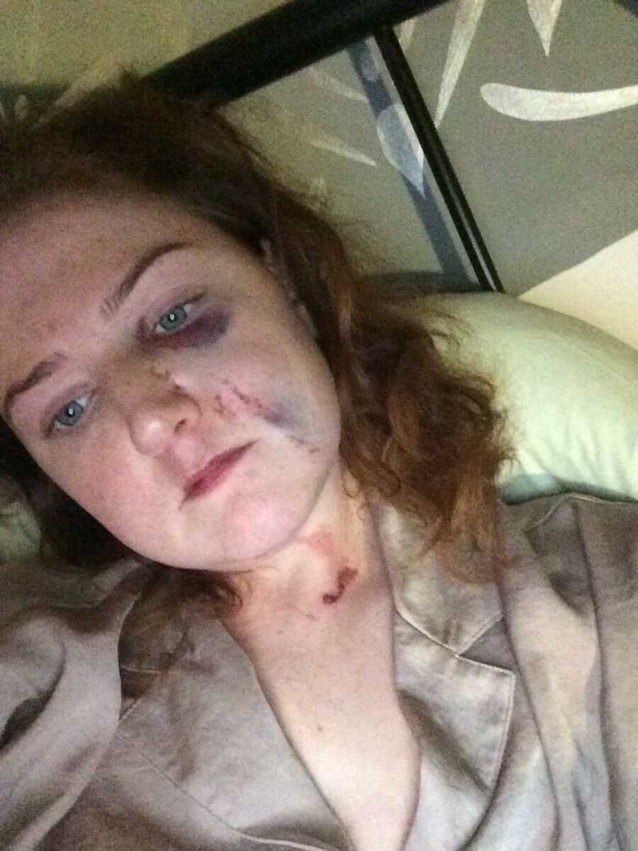 woman takes selfie with bruising on face and neck after drunk driving accident