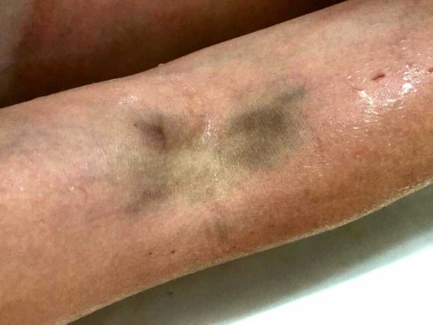 Green bruises on arm of patient with Raynaud's Disease
